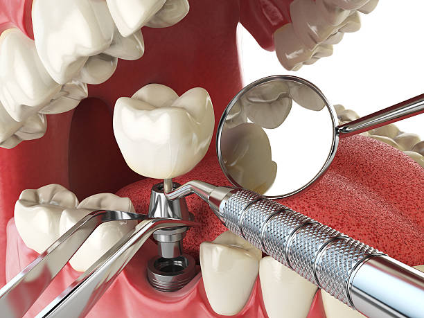 Best Lost Filling or Crown Replacement in Yorkshire, VA